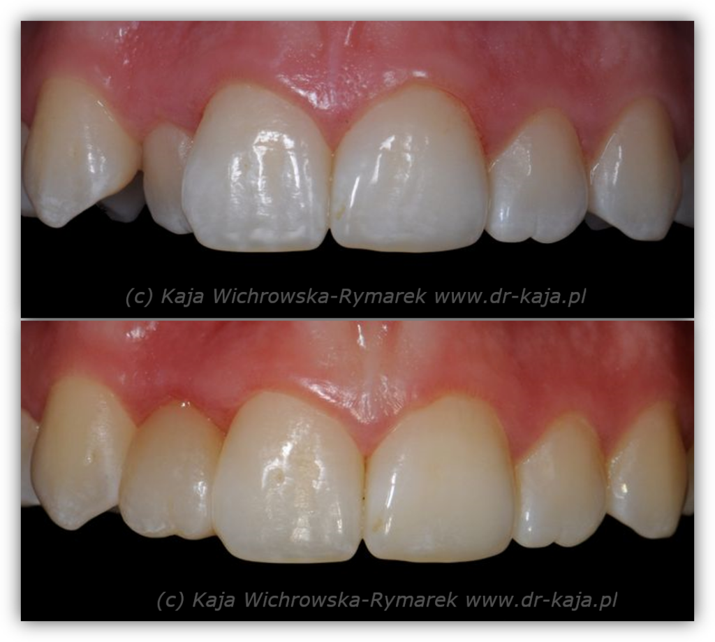 Nadbudowa zęba 12 jako rozwiązanie alternatywne, do czasu podjęcia leczenia ortodontycznego.